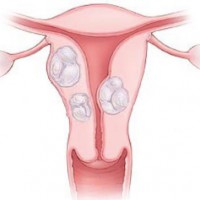 Фибромиома матки — симптомы, причины, способы лечения заболевания