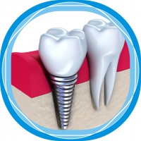 Зубные импланты — преимущества и недостатки