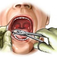 Удаление зуба мудрости — описание процедуры и возможные осложнения