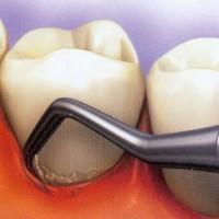 Как удалить зубной камень в домашних условиях — рецепты народной медицины