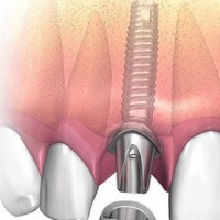 Протезирование зубов на имплантах: прочность и комфорт